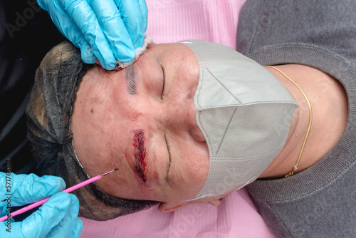 A male customer bleeds excessively from a microblading procedure, resulting from lack of sleep or caffeine and alcohol consumption.