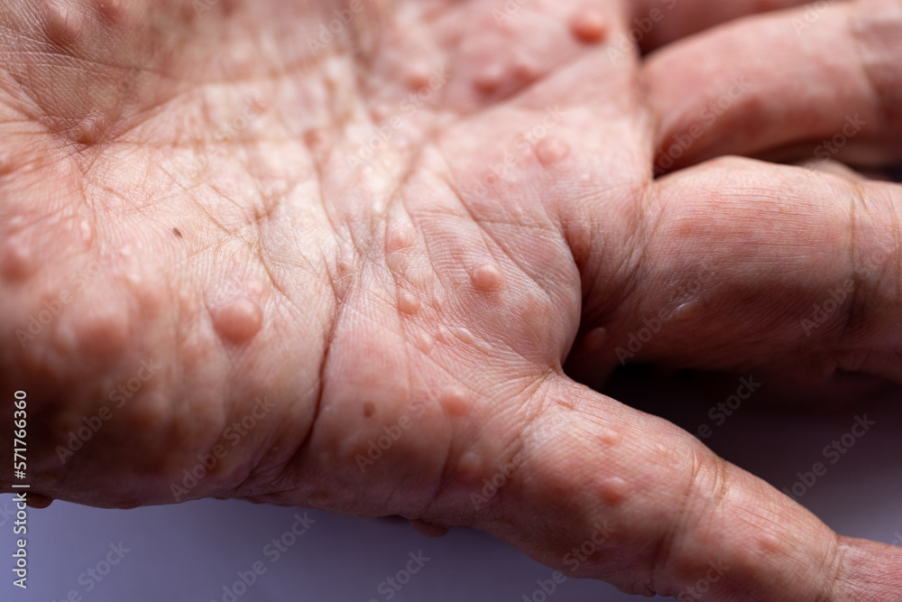 Fototapeta premium Background of human skin with Neurofibromatosis are a group of genetic disorders that cause tumors to form on nerve tissue, These tumors can develop anywhere in the nervous system.