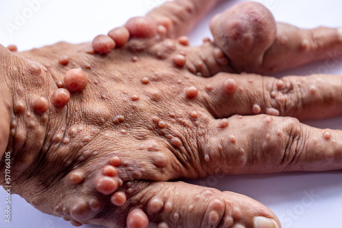 Background of human skin with Neurofibromatosis are a group of genetic disorders that cause tumors to form on nerve tissue, These tumors can develop anywhere in the nervous system. photo