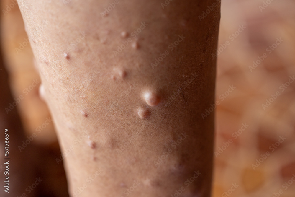 Fototapeta premium Background of human skin with Neurofibromatosis are a group of genetic disorders that cause tumors to form on nerve tissue, These tumors can develop anywhere in the nervous system.