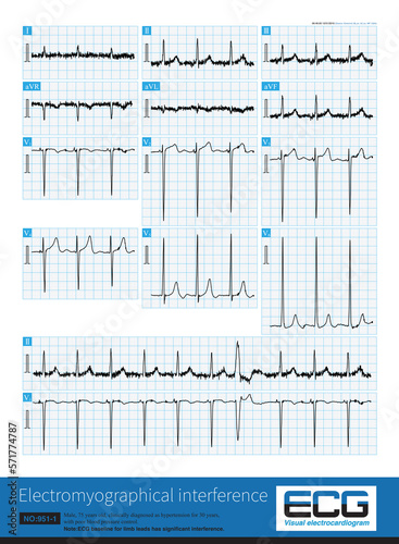 When the baseline of ECG is interfered by its own or external electrical signal, it will affect the shape and measured value of ECG wave, especially ST segment offset amplitude.