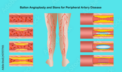 Diagram showing angioplasty for peripheral artery disease illustration. Concept of dry skin, old senior people, varicose veins and DVT . photo