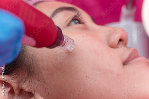 An esthetician uses a microneedling pen on the cheeks of a female customer. Minimally invasive treatment at an aesthetic center and dermatology clinic.
