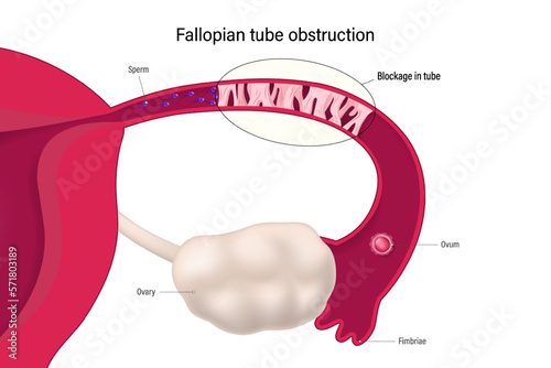 Fallopian tube obstruction. Block fallopian tube. Uterus and uterine tubes. Female reproductive system. Sperm cannot pass through and mix with the egg. Considered one of the causes of infertility. photo
