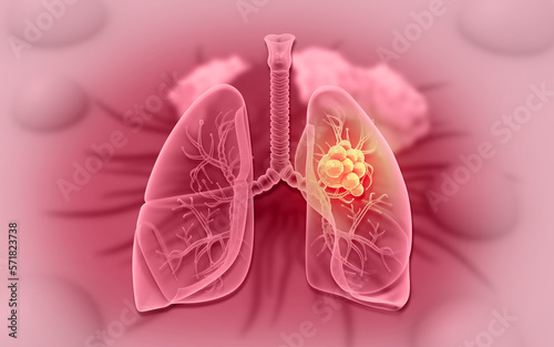 Fototapeta Naklejka Na Ścianę i Meble -  Lungs cancer concept. 3d illustration..