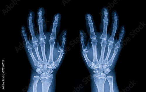 Blue tone radiograph on dark background in hospital.Doctor used xray for diagnosis of the illness of patient.Normal x-ray of both hands. Osteoarthritis of hand and joint. X-ray both hands in hospital.