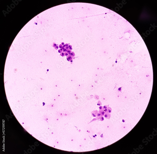 Ascetic fluid cytology, Malignant cells, Metastatic adenocarcinoma, microscopically show atypical epithelial cells, small clusters, background show inflammatory cells and fluidly material. photo