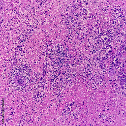 Perianal abscess tissue: Foreign body granuloma, microscopically show granuloma, cluster of epithelioid cells, lymphocytes, histiocytes foreign body giant cells and plasma cells. no malignancy. photo
