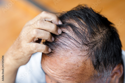 Old man's hand holding his oily hair and falling off, causing a bald scalp. Elderly health concept.