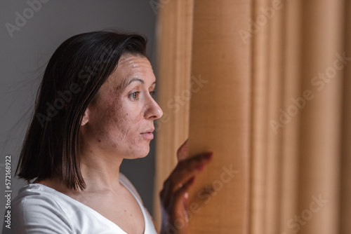 Photo of woman with dry skin looking in the window.