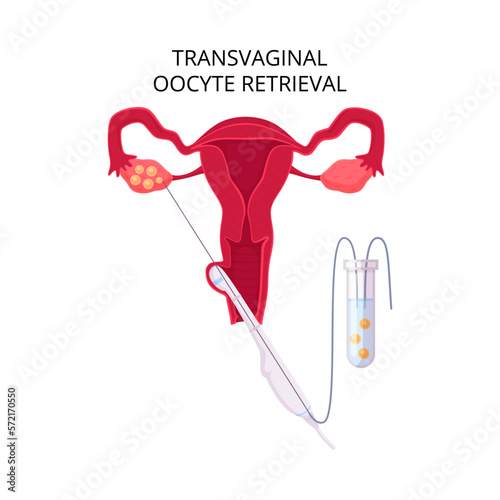 Transvaginal Retrieval Flat Composition