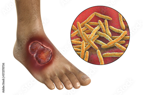 Buruli ulcer on a patient foot, 3D illustration. The disease caused by Mycobacterium ulcerans bacteria photo