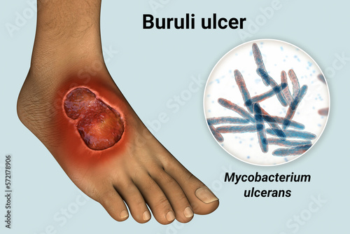 Buruli ulcer on a patient foot, 3D illustration. The disease caused by Mycobacterium ulcerans bacteria