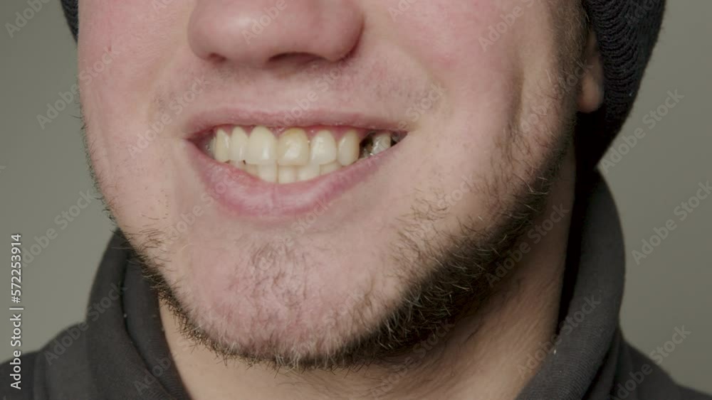 Big smile of a bearded man. Crooked teeth and broken teeth. Teeth that require dental and orthodontic treatment. Teeth that need to be professionally cleaned and treated for caries Big smile of a bearded man. Crooked teeth and broken teeth. Teeth that require dental and orthodontic treatment. Teeth that need to be professionally cleaned and treated for caries