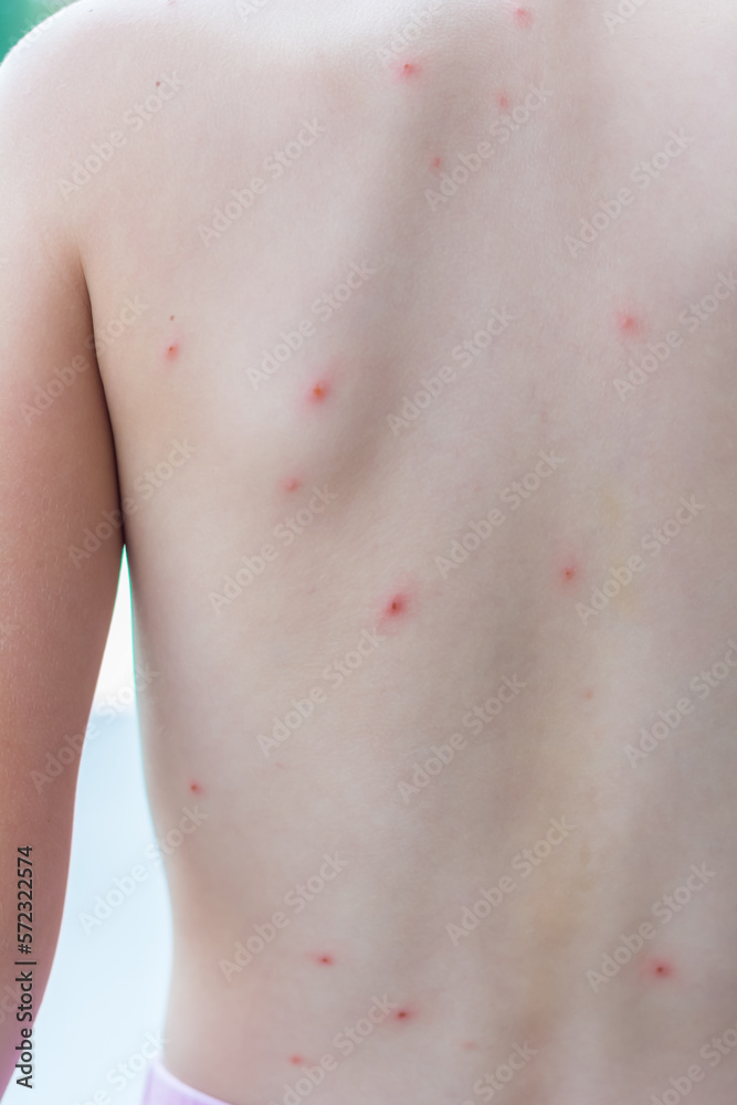 close-up photo of a child with chicken pox close-up photo of a child with chicken pox