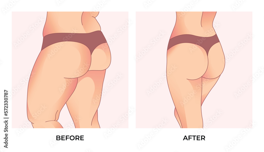 Thigh fat. Before and after weight loss, woman body shape transformation, Fat To Fit. - obrazy, fototapety, plakaty 