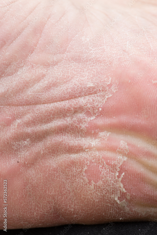 Foot skin Cracked up dead skin peel desquamation medical condition flaking Foot skin Cracked up dead skin peel desquamation medical condition flaking