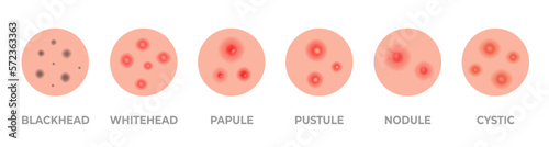 Acne types set. Skin pimples, blackheads and face comedones. Acne skin types - blackheads, whiteheads, papules, pustules, cystic and nodular