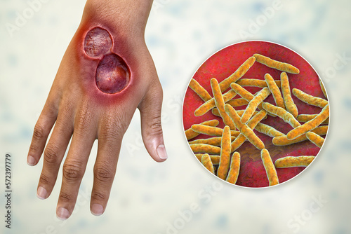 Buruli ulcer on an arm, 3D illustration. The disease caused by Mycobacterium ulcerans bacteria photo