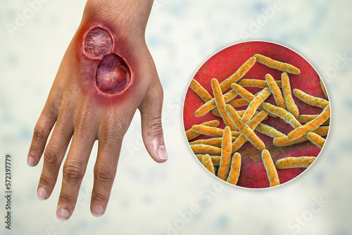Konstfotografi Buruli ulcer on an arm, 3D illustration