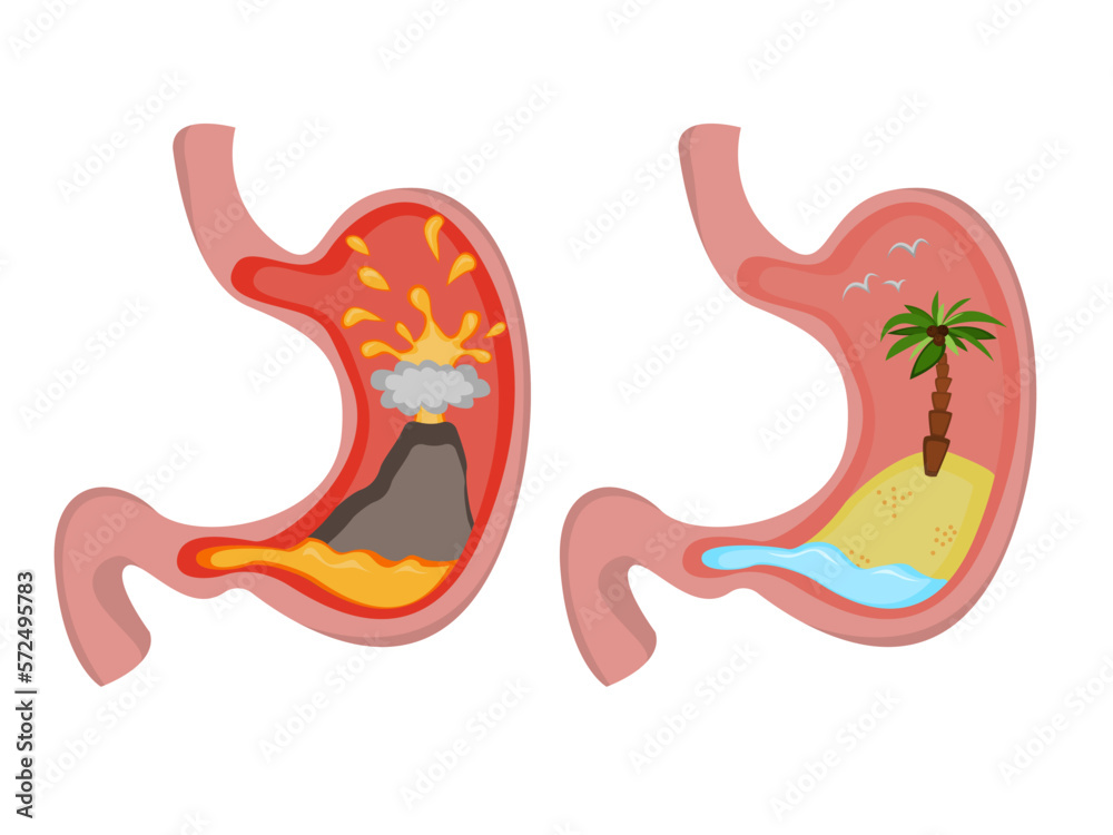 Fototapeta premium Before and after heartburn treatment. Erupting volcano as acid indigestion and island in ocean as healthy condition, stomach illustrations on white background. Gastroesophageal reflux disease