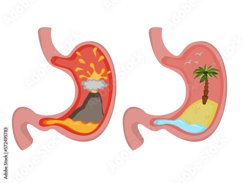 Before and after heartburn treatment. Erupting volcano as acid indigestion and island in ocean as healthy condition, stomach illustrations on white background. Gastroesophageal reflux disease