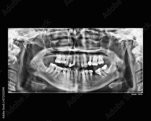 Dental panoramic x-ray of adult woman