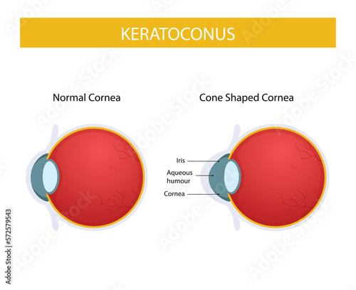 Keratoconus disease, infographic design illustration of keratoconus photo