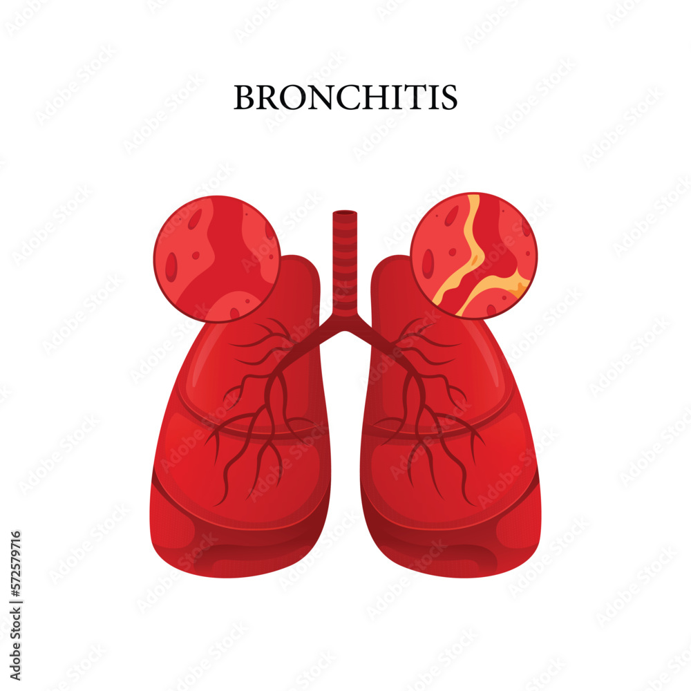 Bronchitis disease vector, illustration design for medical Bronchitis disease vector, illustration design for medical