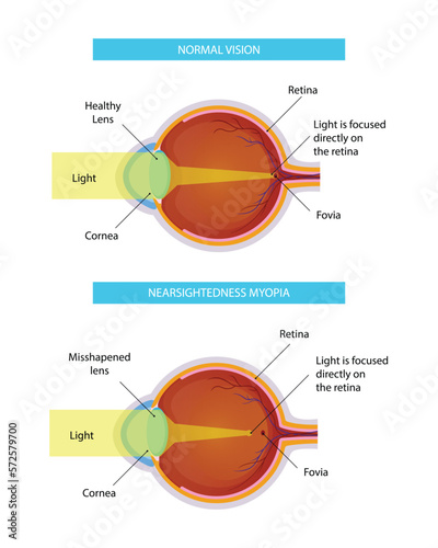 Myopia disease vector infographic, design illustration
for medical