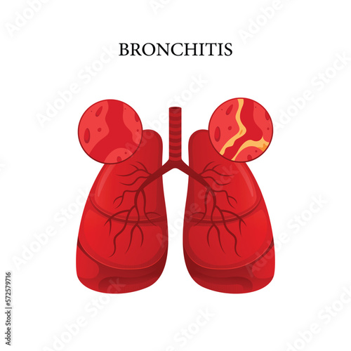 Bronchitis disease vector, illustration design for medical