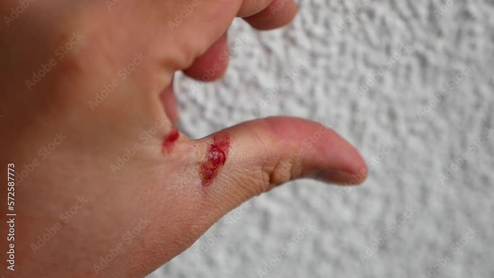 work accident a human hand injured after a work accident, hand injuries,
