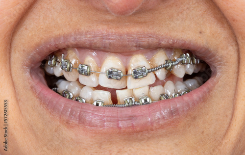 Metal braces on teeth, mouth of middle age Indian Asian woman