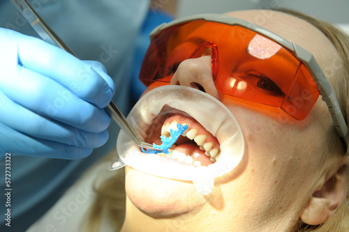 dentistry close-up doctor's hand removes hardened liquid rubber dam to isolate gums from active substance of teeth whitening glasses on woman protecting from photopolymer whitening lamp by American photo