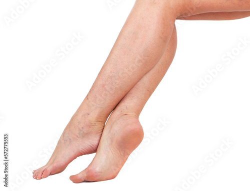 Legs of a woman. Skin with vascular stars. 