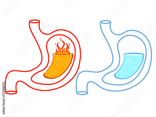 Before and after heartburn treatment. Lava as acid indigestion and water as healthy condition, stomach illustrations on white background. Gastroesophageal reflux disease