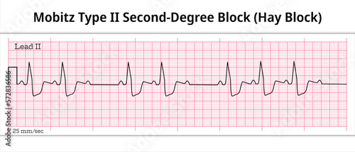 Hay Block - ECG Mobitz Type 2 Second Degree Atrioventricular Block - 2nd degree AV Block - 8 Second ECG Paper - Electrocardiography Vector Medical Illustration