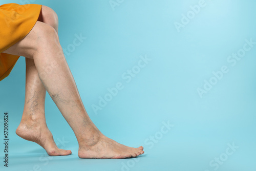Closeup view of woman with varicose veins on light blue background. Space for text