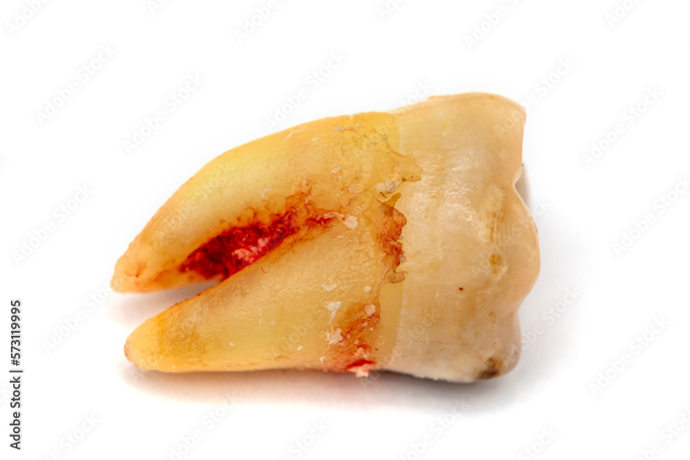 Close up shot of a molar tooth decay extracted and placed on a white background. The root of the tooth is not long, there is a small amount of bleeding. Selective focus. Close up shot of a molar tooth decay extracted and placed on a white background. The root of the tooth is not long, there is a small amount of bleeding. Selective focus.