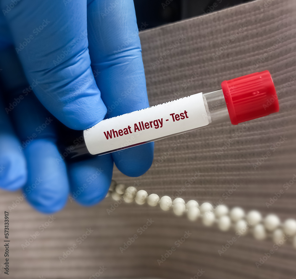Blood Sample For Wheat Allergy Blood Test Test Tube In Doctor Hands blood-sample-for-wheat-allergy-blood-test-test-tube-in-doctor-hands