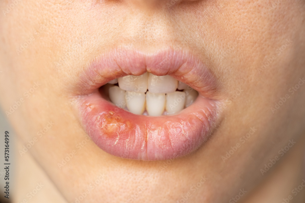 Simplex herpes on the lips of a girl closeup, a group of viral
