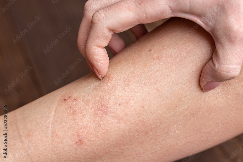 Dry human skin of a woman leg. Concept of skin rehydration cosmetics to keep the skin young. Skin diseases Dry human skin of a woman leg. Concept of skin rehydration cosmetics to keep the skin young. Skin diseases