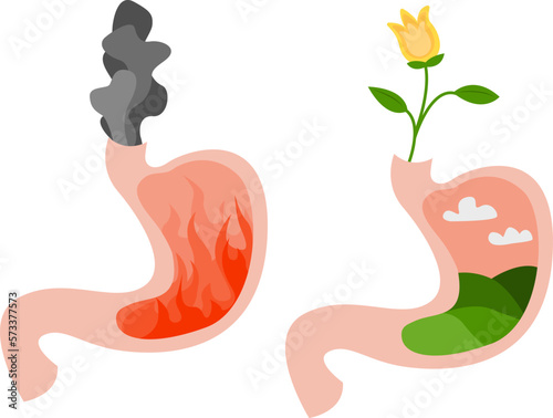 Before and after heartburn treatment. Fire with smoke as acid indigestion and green field as healthy condition, stomach illustrations on white background. Gastroesophageal reflux disease