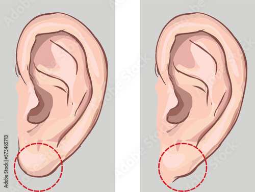 Free earlobe and attached earlobe in comparison. stock illustration photo