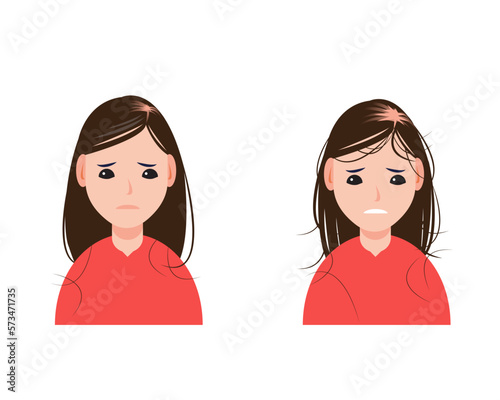 Female pattern baldness, alopecia, type of hair loss in women vector isolated on white background. Step of hair losing to alopecia. Hair problem concept illustration.