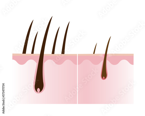 Comparison of healthy and losing hair with scalp layer vector isolated on white background. Hair density, loss, alopecia, baldness and hairless. Hair anatomy concept illustration. 