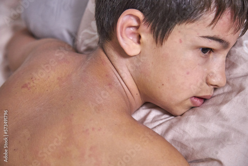 Wallpaper Mural Itchy skin, dermatitis, food allergies. Baby showing her back with acne, red spots. Baby's having itching, scratching her body with allergy rash Torontodigital.ca