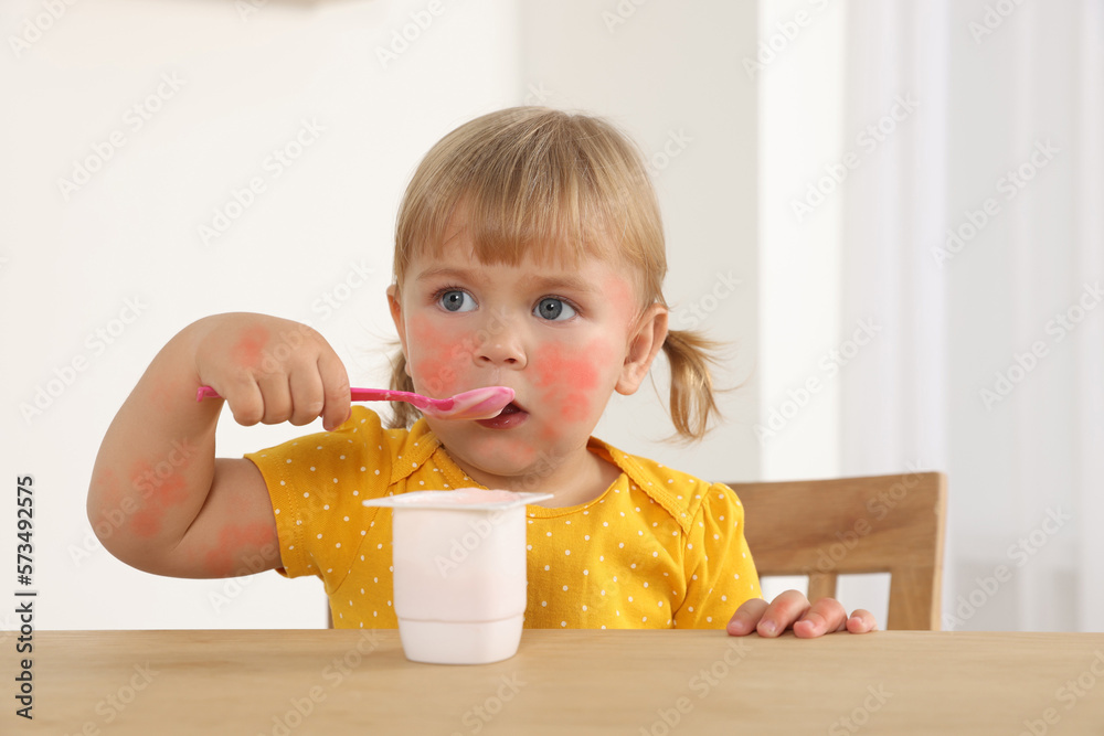 Cute little child with allergic redness eating tasty yogurt at wooden table indoors Cute little child with allergic redness eating tasty yogurt at wooden table indoors