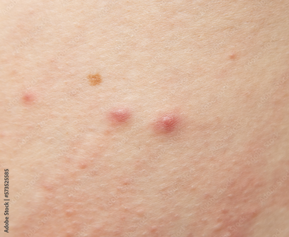 inflamed acne on the skin as a background