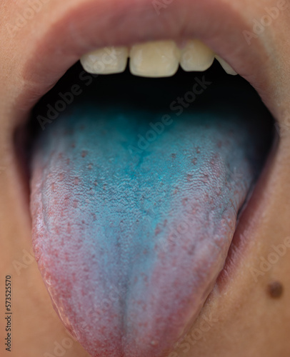 blue tongue in a child from dyes photo